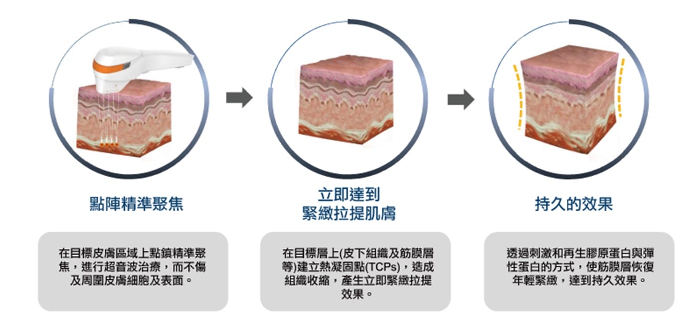 Tightan 音波拉提原理示意圖